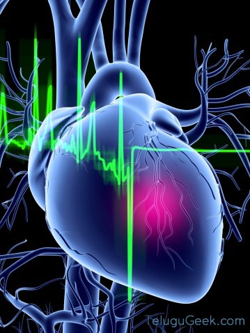 CardioMEMS – వృద్ధులకు తోడుగా..