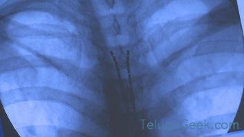pain relief fiber in back bone