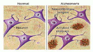 alzdisease