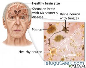 alzhimers1
