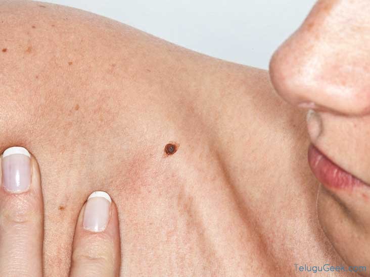 Dermasensor: ఈ పెన్ను స్కిన్ కాన్సర్ ను గుర్తించగలదు