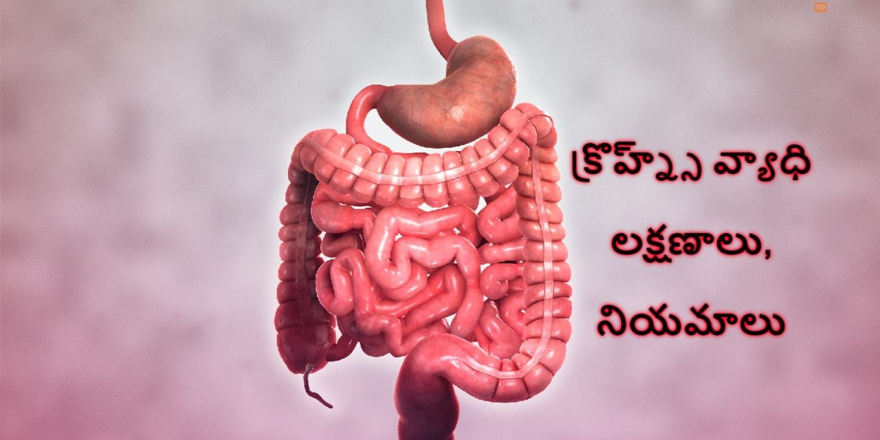 క్రొహ్న్స్ వ్యాధి – లక్షణాలు, నియమాలు