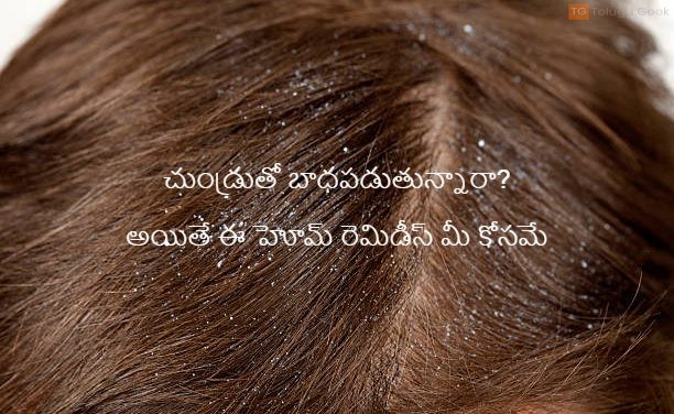 చుండ్రుతో బాధపడుతున్నారా? అయితే ఈ హోమ్ రెమిడీస్ మీ కోసమే