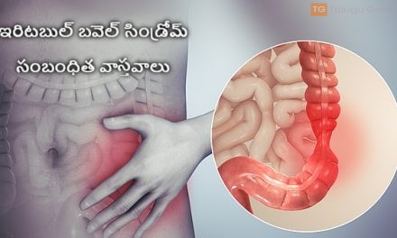 ఇరిటబుల్ బవెల్ సిండ్రోమ్ – సంబంధిత వాస్తవాలు